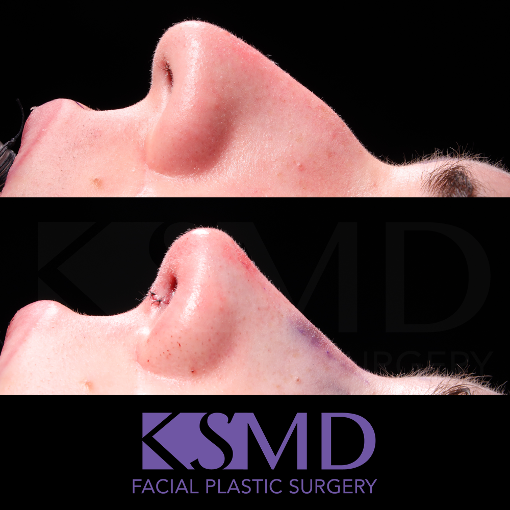 SS profile 2 intraop