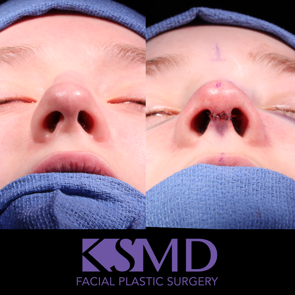 ZA basal intraop
