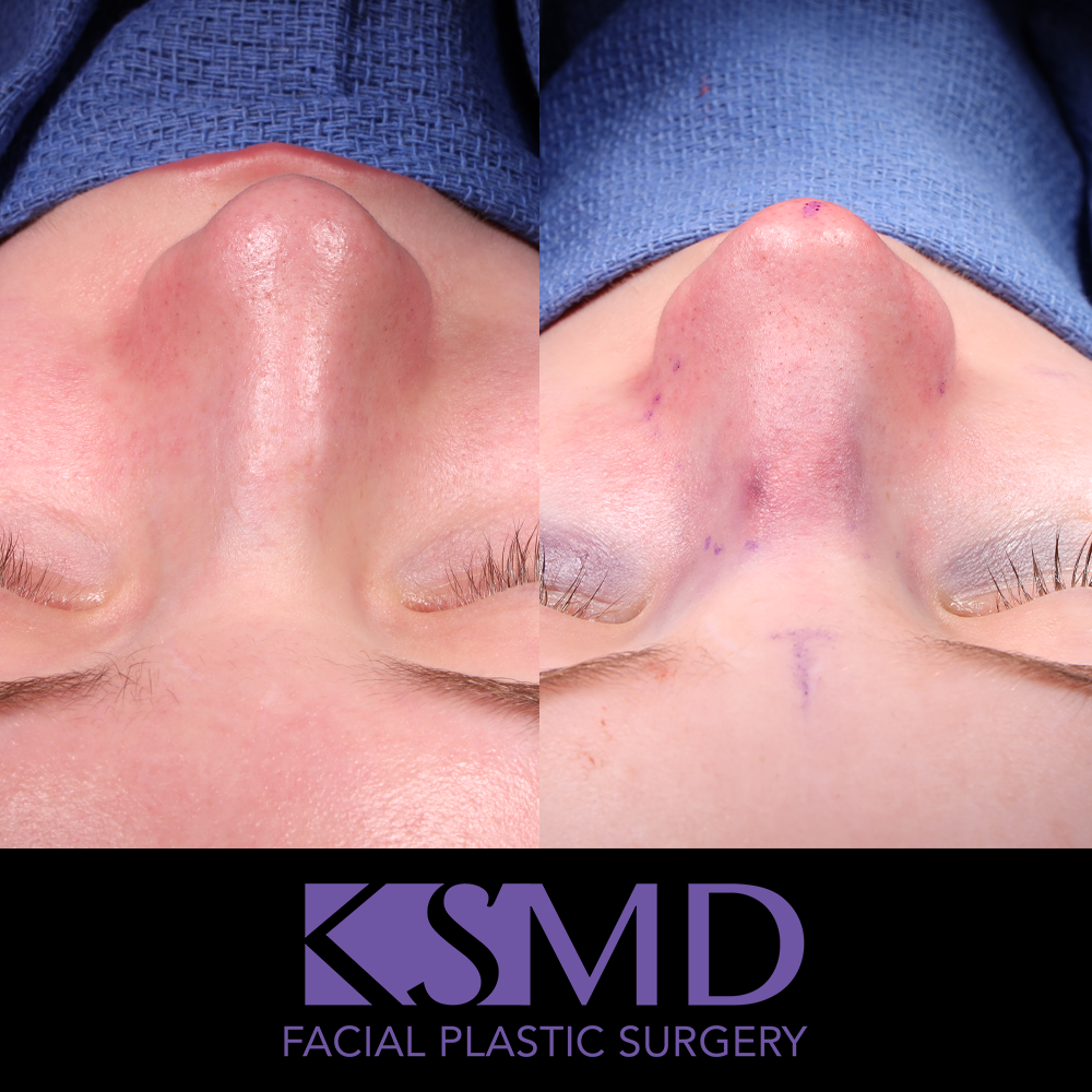 ZA frontal intraop